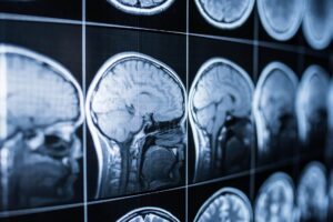 traumatic brain injury scans